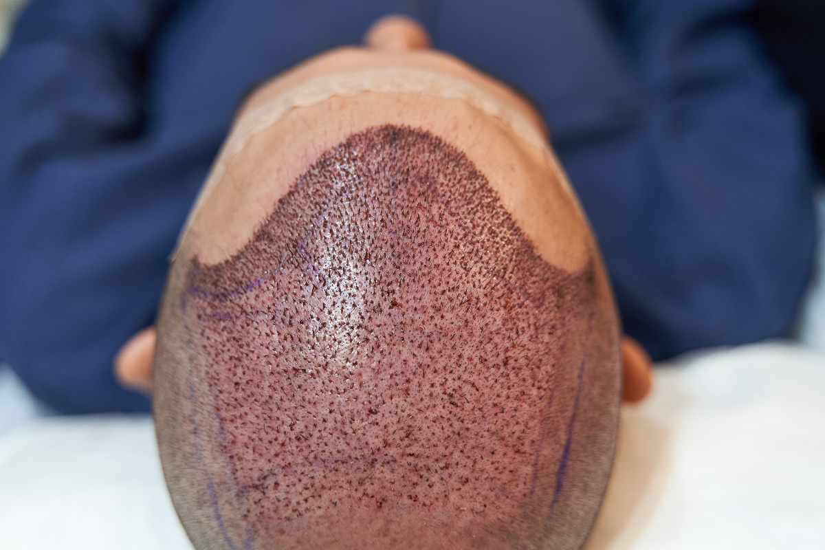 Anestesia para Transplante Capilar